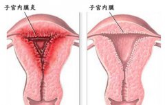 子宫内膜炎有哪些危害