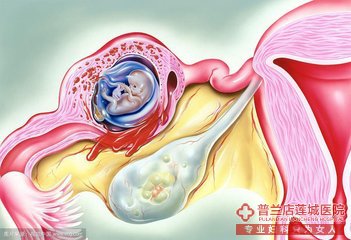 大连金州玛丽亚妇科医院宫外孕怎么办？